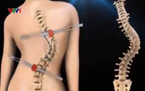 Phương pháp mới trong phẫu thuật, chỉnh hình cột sống