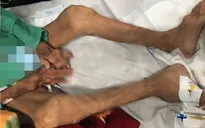 10 năm tự mua thuốc trị gout, người đàn ông bị biến dạng tay chân