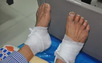 Chườm nóng bằng lá ngải cứu, bệnh nhân đái tháo thường bị bỏng độ 3