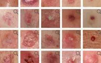 Những sự thật cần biết về ung thư da