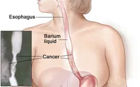 Dấu hiệu cảnh giác với ung thư thực quản
