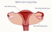Bùng nổ căn bệnh lây lan qua đường tình dục khiến phụ nữ vô sinh