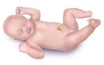 Bệnh phình đại tràng bẩm sinh ở trẻ