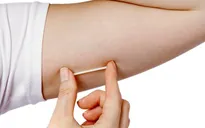 8 điều cần biết về que cấy tránh thai dưới da
