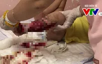 Thương tâm: Cháu bé 20 tháng tuổi bị bố lùi xe chèn nát chân