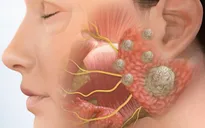 Ung thư tuyến nước bọt - Căn bệnh nguy hiểm