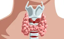 Sút 15kg vì bệnh lý hiếm gặp ở tuyến giáp