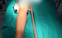 Hy hữu: Bé trai bị thanh sắt đâm xuyên bộ phận sinh dục