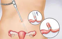 Hơn 240.000 người mắc ung thư buồng trứng mỗi năm