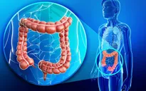 Sàng lọc sớm ung thư đại trực tràng