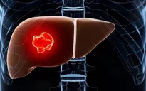 Viêm gan C: Tăng nguy cơ mắc ung thư gan và các bệnh ung thư khác