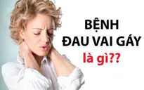 Giới văn phòng và nguy cơ thoái hóa đốt sống cổ
