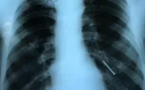 Cây đinh gỉ sét chui vào phổi người đàn ông suốt 4 tháng