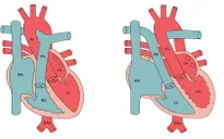 Cứu sống kịp thời trẻ sơ sinh bị chuyển vị đại động mạch