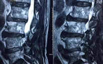 Nguyên nhân và triệu chứng bệnh thoát vị đĩa đệm