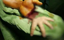 Nối bàn tay thành công cho bệnh nhân bị chém lìa
