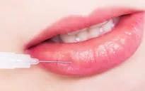 Sự thật ít ai biết của việc tiêm filler môi làm đẹp