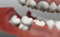 Đau răng khôn: Những điều quan trọng bạn cần biết