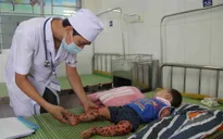 Bắc Ninh: gia tăng bệnh tay chân miệng ở trẻ nhỏ