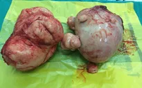 Cắt u xơ tử cung 4,5kg cho bệnh nhân tâm thần