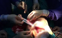 Cắt và tạo hình tuyến vú điều trị ung thư vú giai đoạn sớm