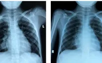 Suýt vỡ động mạch phổi do bệnh hiếm