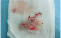 Cảnh báo: Nhiều trẻ mắc dị vật âm đạo