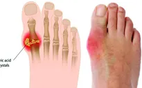 Nguy cơ tử vong cao khi bị đau tim đối với bệnh nhân gout