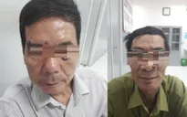 Ung thư tế bào đáy - Những điều cần biết về loại ung thư da hay gặp nhất