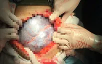Hút 7 lít dịch trong khối u buồng trứng một phụ nữ