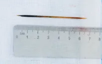 Ngủ quên, người đàn ông nuốt luôn cây tăm dài 7cm
