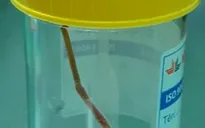 Tăm tre dài 6cm đâm thủng ruột bé trai