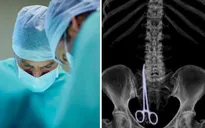 Bác sĩ để quên kéo phẫu thuật trong bụng bệnh nhân