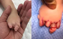 Mắc bệnh lạ: Ngón tay, ngón chân của bé gái dính chặt vào nhau