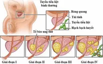 Điều trị ung thư tuyến tiền liệt di căn