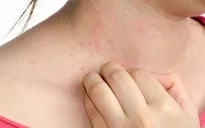 Các bệnh da liễu thường gặp vào mùa hè