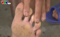 Cẩn trọng với nước ăn chân - Bệnh về da phổ biến mùa mưa lũ