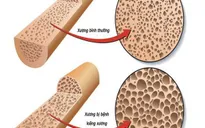 Nguyên nhân và triệu chứng bệnh loãng xương