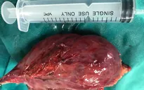 Phẫu thuật nội soi cắt bỏ khối u trung thất khổng lồ