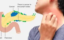 Giải đáp thắc mắc về ung thư tuyến tụy