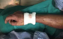 Người đàn ông bị đứt động mạch, dây thần kinh do tai nạn lao động