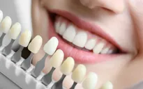 Các phương pháp làm trắng răng