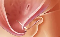 Dị tật lỗ tiểu thấp ở trẻ nhỏ
