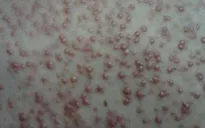 Mụn trứng cá - Phân loại để dễ điều trị
