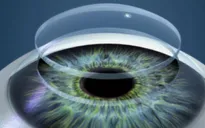 In 3D thành công mắt nhân tạo