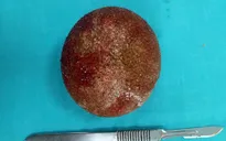 Ngỡ ngàng viên sỏi bàng quang nặng 0,5kg ở một cụ ông
