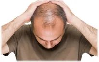 Phương pháp chữa trị bệnh hói đầu
