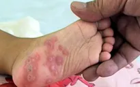 Một trẻ tử vong do bệnh tay chân miệng ở Bến Tre