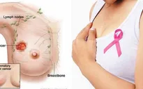 12 yếu tố nguy cơ gây ung thư vú