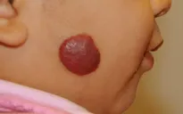 U máu trẻ em có nguy hiểm?